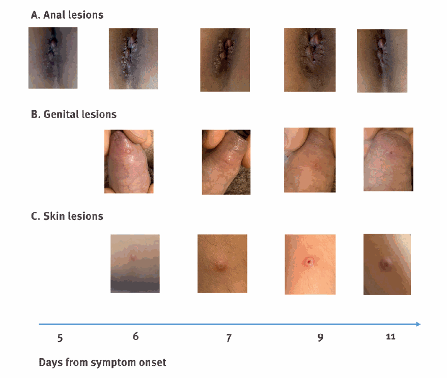 Images of skin lesions from monkeypox virus